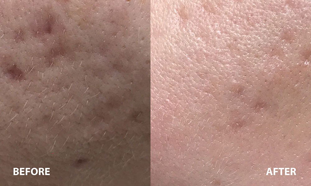 chemical peel before and after