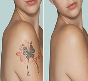 Saline tattoo removal while pregnant
